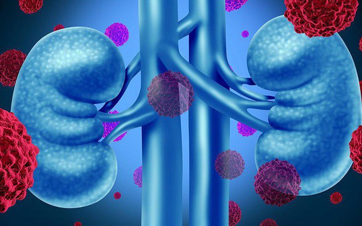 Người phụ nữ 67 tuổi bất ngờ phát hiện ung thư thận giai đoạn sớm từ 1 việc nhiều người Việt bỏ qua