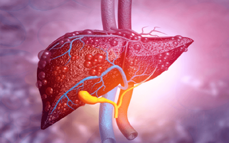 Người đàn ông 34 tuổi suy gan cấp vì sai lầm trong lúc giảm cân nhiều người Việt mắc phải