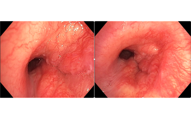 Người đàn ông 32 tuổi phát hiện ung thư phổi hiếm gặp từ dấu hiệu nhiều người Việt mắc phải