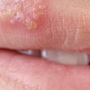 Cách phòng tránh lây nhiễm Herpes sinh dục