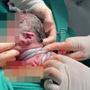 Em bé ở Hà Nội chào đời với dây rốn quấn 3 vòng cổ