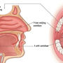 Các phương pháp điều trị viêm VA ở trẻ nhỏ