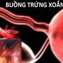 Bé 13 tuổi ở Bình Dương suýt bị hoại tử buồng trứng từ dấu hiệu nhiều người Việt bỏ qua