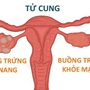 Cô gái 18 tuổi ở Hà Nội bất ngờ phát hiện buồng trứng đa nang từ dấu hiện nhiều phụ nữ Việt bỏ qua