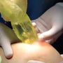 Người phụ nữ bị rò rỉ, vỡ túi ngực sau 14 năm nâng ngực: Túi ngực có thời hạn được bao lâu?