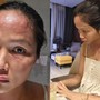Hoa hậu H'Hen Niê bất ngờ chia sẻ mặt sưng nề, mẩn đỏ sau sinh con, căn bệnh cô mắc nguy hiểm thế nào?