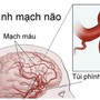 Người phụ nữ đi khám vì đau đầu bất ngờ phát hiện phình mạch máu não nguy hiểm