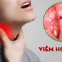 Thói quen giúp giảm triệu chứng viêm họng khi trời lạnh: Nên và không nên ăn gì để nhanh khỏi?