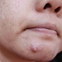 Cách xử lý mụn bọc sưng to an toàn, hạn chế thâm sẹo