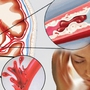 Cô gái 22 tuổi bị đột quỵ xuất huyết não, từng xuất hiện dấu hiệu này nhưng đã bỏ qua