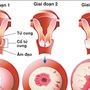 Chị em cần biết điều này trước khi làm tầm soát ung thư cổ tử cung