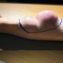 Đau cổ tay kéo dài, cô gái 23 tuổi bất ngờ phát hiện mắc ung thư