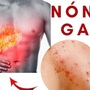 Mùa hè, 4 dấu hiệu cơ thể cảnh báo bạn đang bị nóng gan