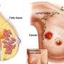 Người phụ nữ 62 tuổi ở Hà Nội phát hiện sớm ung thư vú từ việc làm quan trọng này