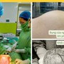 Người phụ nữ 42 tuổi ở Hòa Bình có khối u xơ tử cung 'khủng' như mang thai 3 tháng từ sai lầm nhiều chị em Việt mắc phải