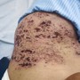 Người phụ nữ 73 tuổi nhập viện trong tình trạng đau đớn, tổn thương da nặng do sai lầm trong điều trị zona thần kinh nhiều người Việt mắc phải