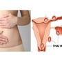 Người phụ nữ 36 tuổi nhập viện vì thai ngoài tử cung vỡ, thừa nhận một sai lầm nhiều phụ nữ Việt mắc phải