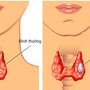 Người phụ nữ 60 tuổi cùng lúc mắc 2 thể ung thư tuyến giáp thừa nhận sai lầm nhiều người Việt mắc phải