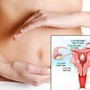 Người phụ nữ 48 tuổi ở Phú Thọ phát hiện u xơ tử cung nặng hơn 1,5kg từ dấu hiệu nhiều chị em Việt bỏ qua