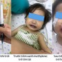 Bé 16 tháng tuổi nguy kịch sau bữa ăn trưa do mẹ nấu, bác sĩ chỉ rõ nguyên nhân