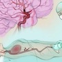 Người phụ nữ 57 tuổi đột quỵ liên tiếp 2 lần trong 2 ngày thừa nhận bỏ qua dấu hiệu báo bệnh này