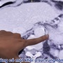 Người đàn ông bất ngờ phát hiện bị ung thư biểu mô từ dấu hiệu nhiều người Việt bỏ qua