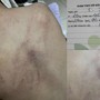 Bộ Y tế vào cuộc vụ bé gái 4 tuổi nghi bị cô giáo đánh đập, ném vào tường ở trường mầm non