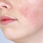 7 tác dụng phụ thường gặp khi sử dụng retinol và cách phòng ngừa