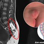 Bé 10 tuổi ở Phú Thọ bị dị tật tủy sống từ dấu hiệu nhiều người Việt bỏ qua