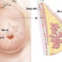 6 nhóm người có nguy cơ mắc ung thư vú cao, đây là 7 dấu hiệu cảnh báo bệnh, chị em cần cảnh giác