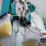 Người đàn ông 34 tuổi máu đục như sữa vì viêm tụy cấp thừa nhận 2 thói quen cần từ bỏ sớm