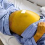 Người phụ nữ 61 tuổi suy gan nặng, nguy cơ tử vong cao do chủ quan với dấu hiệu này