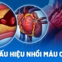 Biến chứng đáng sợ của căn bệnh ông Hoàng Nam Tiến tiết lộ mắc phải trước đó nguy hiểm ra sao?