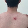 Nam nhân viên văn phòng lở loét toàn thân vì quan hệ tình dục bừa bãi