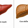 Gan nhiễm mỡ không chừa ai: 8 dấu hiệu sớm cảnh báo bạn đang đối diện nguy hiểm