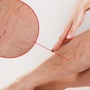 Suy giãn tĩnh mạch: Đừng mắc sai lầm để phải chấp nhận sống chung với bệnh