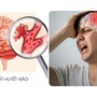 Bác sĩ cảnh báo: Trước 3 ngày nhồi máu não, 90% bệnh nhân đều làm 3 việc này, việc thứ hai bạn vẫn đang làm hàng ngày!