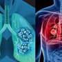 Người đàn ông 68 tuổi phát hiện ung thư phổi di căn từ những dấu hiệu người Việt dễ bỏ qua