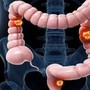 Nam sinh viên 22 tuổi mắc ung thư đại tràng giai đoạn 4 thừa nhận bỏ qua 3 dấu hiệu báo bệnh này