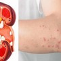 Bất ngờ phát hiện suy thận giai đoạn nặng từ dấu hiệu nhiều người Việt mắc phải nhưng dễ bỏ qua