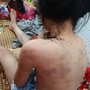 Cao Bằng: Phát hiện con bầm tím khắp người, mẹ sốc khi biết nữ sinh lớp 4 bị nhiều bạn đánh