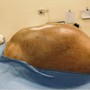 Thiếu nữ 16 tuổi mang khối u buồng trứng gần 15kg: Bác sĩ khuyến cáo không chủ quan với dấu hiệu bất thường