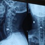 Người đàn ông 43 tuổi đau cổ, tê tay suốt 2 năm vì bệnh lý nhiều người Việt dễ bỏ qua