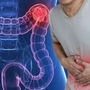 Người đàn ông 45 tuổi phát hiện ung thư đại tràng di căn gan và xương từ dấu hiệu nhiều người Việt mắc phải