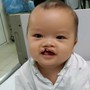 MS 1099: Bé trai 8 tháng tuổi bị bỏ rơi trước cổng chùa cần trợ giúp để phẫu thuật dị tật