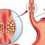 Cô gái 26 tuổi bị loét thực quản vì thói quen nhiều người Việt mắc phải khi uống thuốc