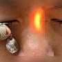 Bé trai 13 tuổi đi cấp cứu với lưỡi câu ghim sâu trong mắt