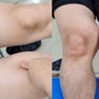 Đùi to bất thường nhưng không đau, người đàn ông 39 tuổi phát hiện ung thư mô mềm hiếm gặp
