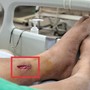 Vết thương do thanh tre đâm vào chân đã liền, người phụ nữ bất ngờ nguy kịch vì nguyên nhân này