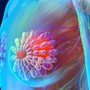 Người phụ nữ 43 tuổi phát hiện ung thư vú giai đoạn sớm từ dấu hiệu nhiều chị em Việt bỏ qua